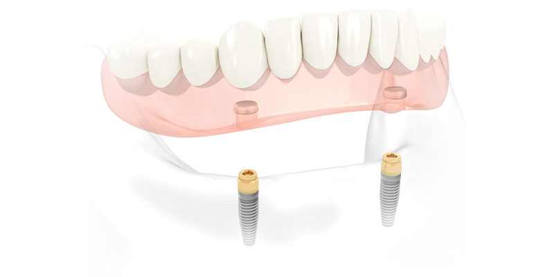 Implant Overdenture at PERFECT SMILE